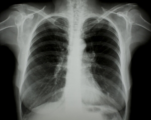 胸部X射线-ID:4041684