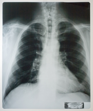 胸部X射线-ID:4041704