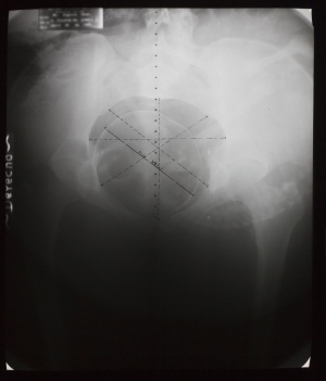 盆腔X射线-ID:4041708