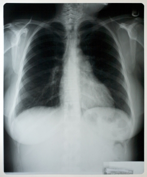 胸部X射线-ID:4041725