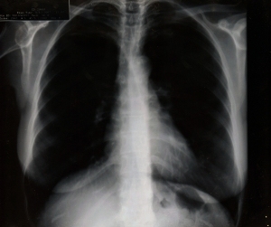 胸部X射线-ID:4041730