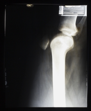 膝关节X射线-ID:4041741
