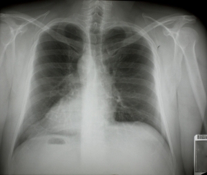 胸部X射线-ID:4041746