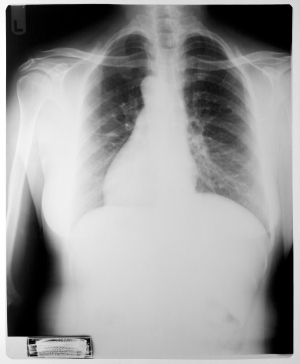胸部X射线-ID:4041747