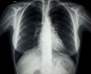 胸部X射线-ID:4041750