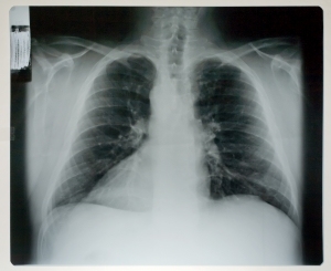 胸部X射线-ID:4041752