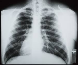 胸部X射线-ID:4041759