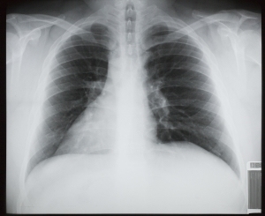 胸部X射线-ID:4041762