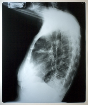 胸部X射线-ID:4041769