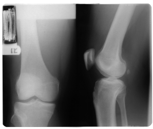 膝关节X射线-ID:4041804
