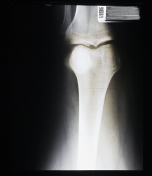 膝关节X射线-ID:4041832